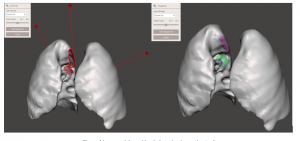 Lung model repairing holes using inspection tool