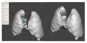 Lung model local smoothing using RobustSmooth brush