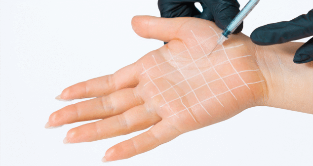 A gloved hand holds a syringe near the palm of another hand, which has a white grid drawn on it. The needle is poised to inject at the intersection of the lines. The background is plain white, drawing focus to the skin and procedural markings.