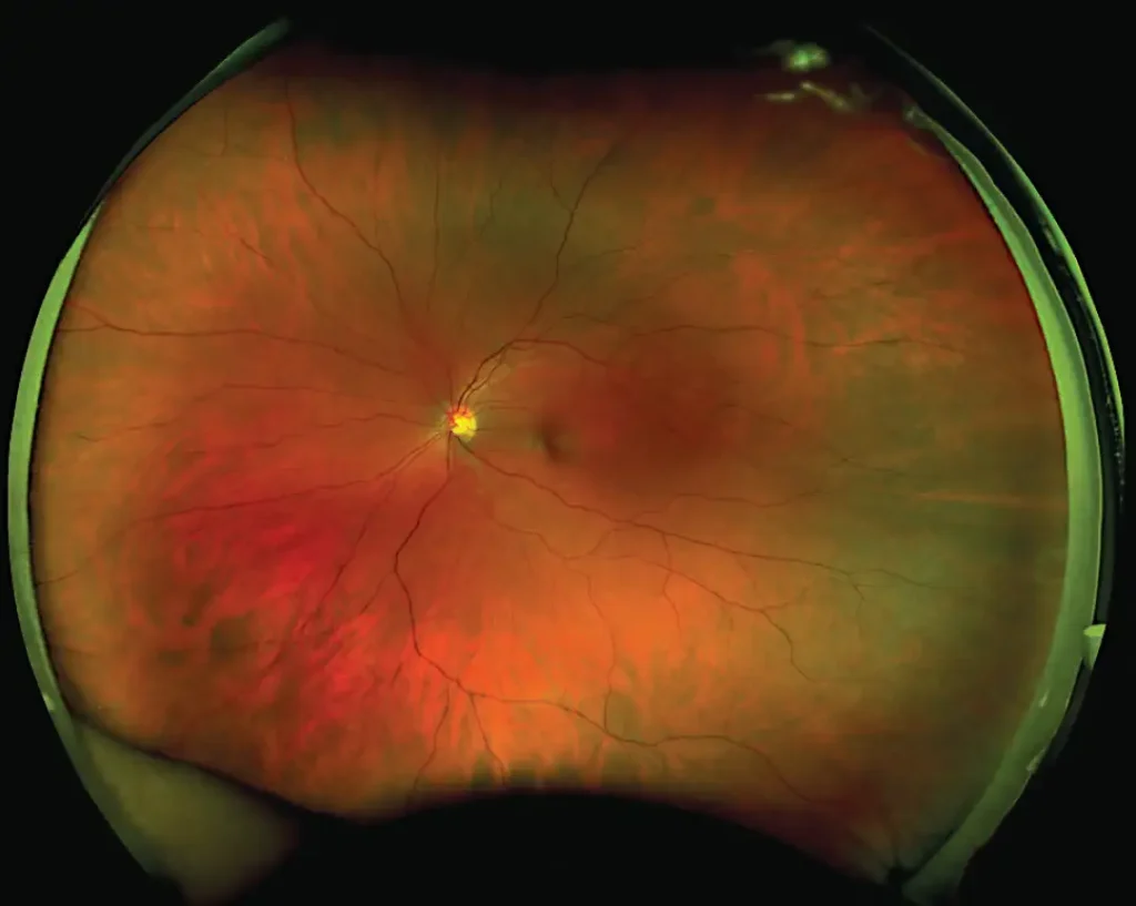 Ultra-wide-field scanning laser ophthalmoscopy image of a human retina showing vascular structure and optic